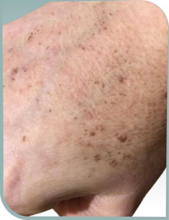 Hand age spots, Before photo (result 8 of 10)