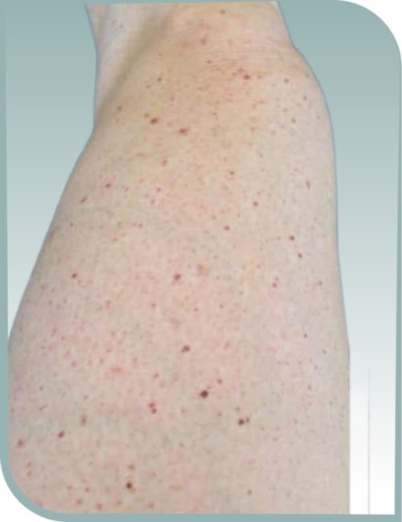 Thigh dark spots, Before photo (result 9 of 10)