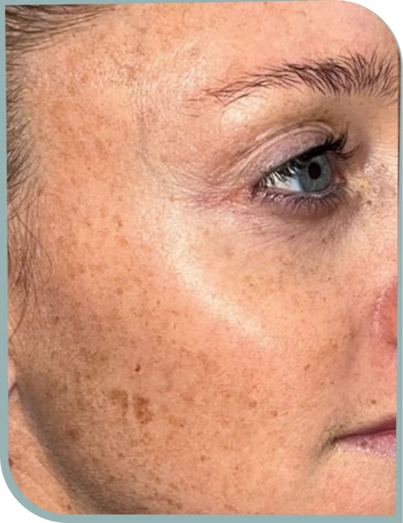Cheek freckling, Before photo (result 10 of 10)