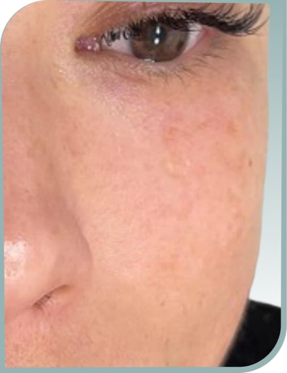 Cheek sun spots, After photo (result 1 of 10)
