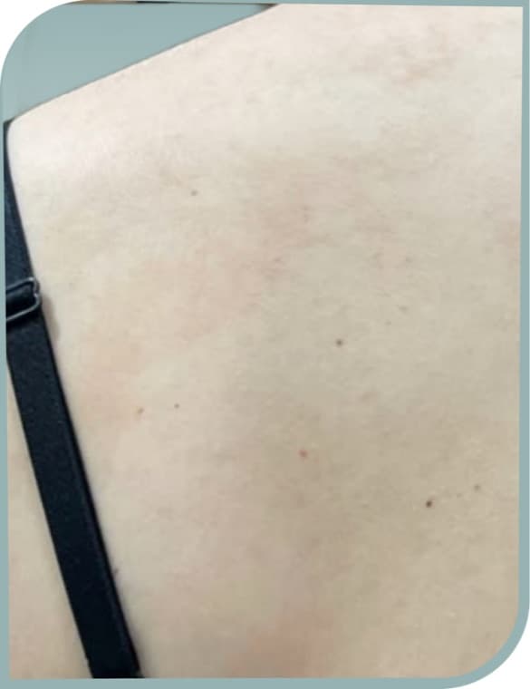 Upper back sun damage, After photo (result 2 of 10)