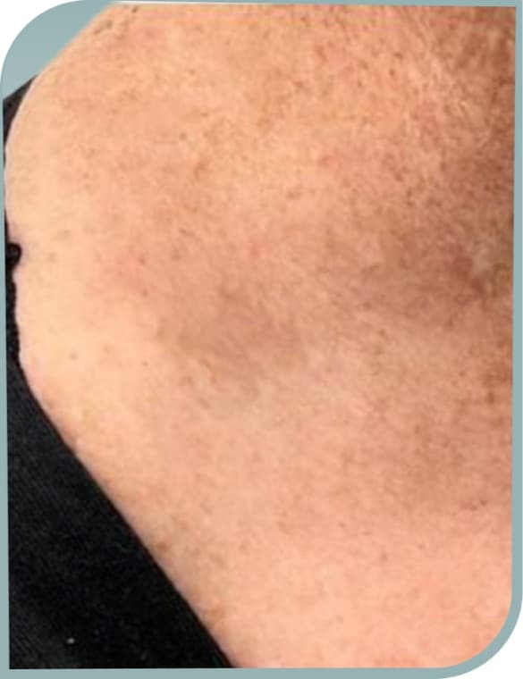 Neck dark spots, After photo (result 3 of 10)