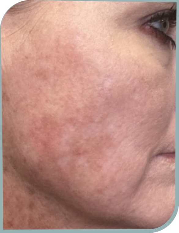 Cheek melasma patch, After photo (result 4 of 10)