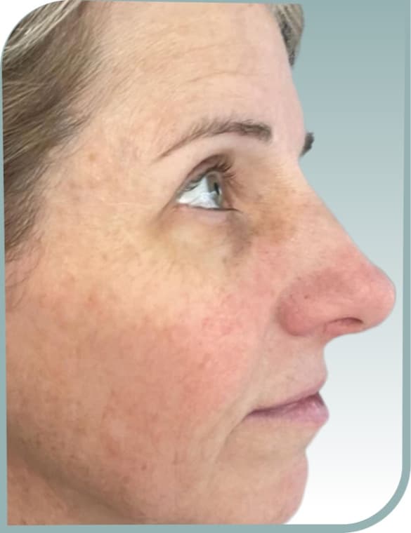 Facial freckling, After photo (result 5 of 10)