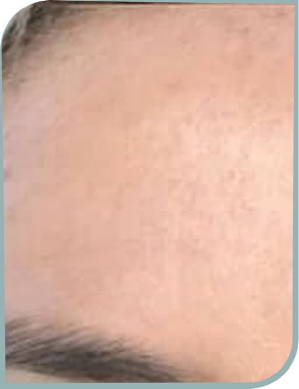 Forehead pigmentation, After photo (result 6 of 10)