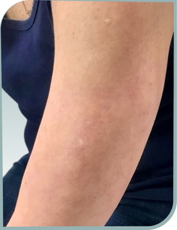 Upper arm sun spots, After photo (result 7 of 10)