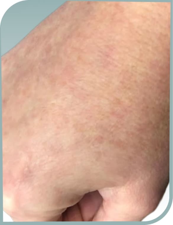Hand age spots, After photo (result 8 of 10)
