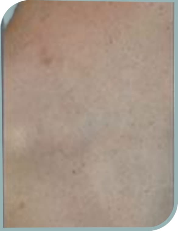 Neck symbol fading, After photo (result 7 of 10)