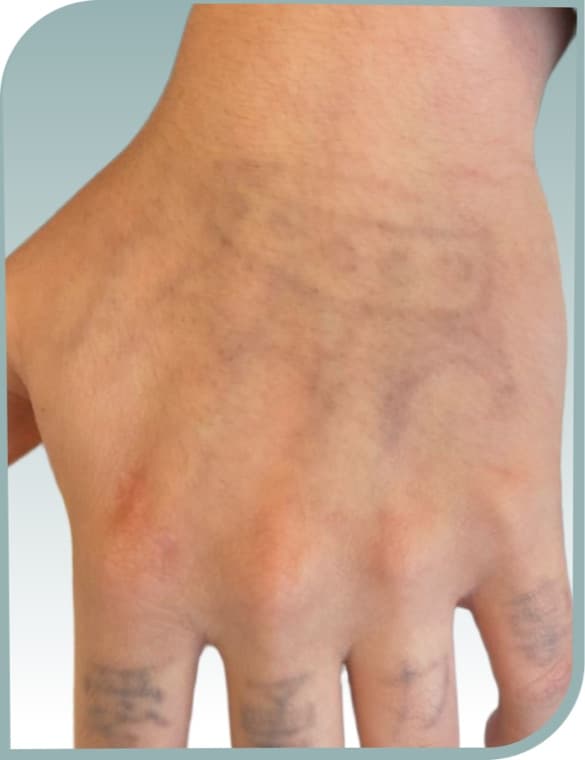 Hand tattoo fading, After photo (result 10 of 10)