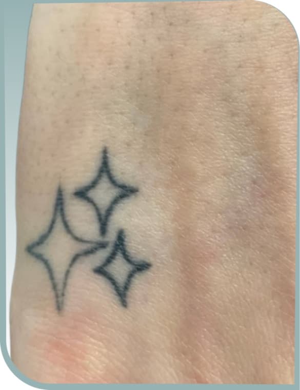 Wrist stars fading, Before photo (result 2 of 10)