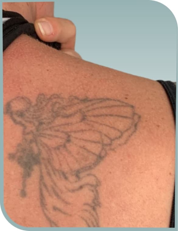 Shoulder figure fading, Before photo (result 3 of 10)