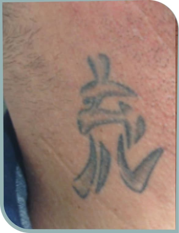 Neck symbol fading, Before photo (result 7 of 10)