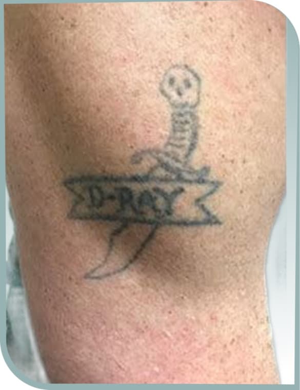 Knee tattoo fading, Before photo (result 8 of 10)