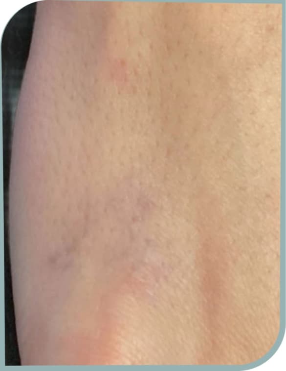 Wrist stars fading, After photo (result 2 of 10)