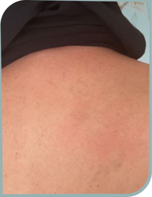 Shoulder figure fading, After photo (result 3 of 10)