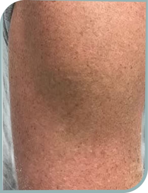 Leg script fading, After photo (result 9 of 10)