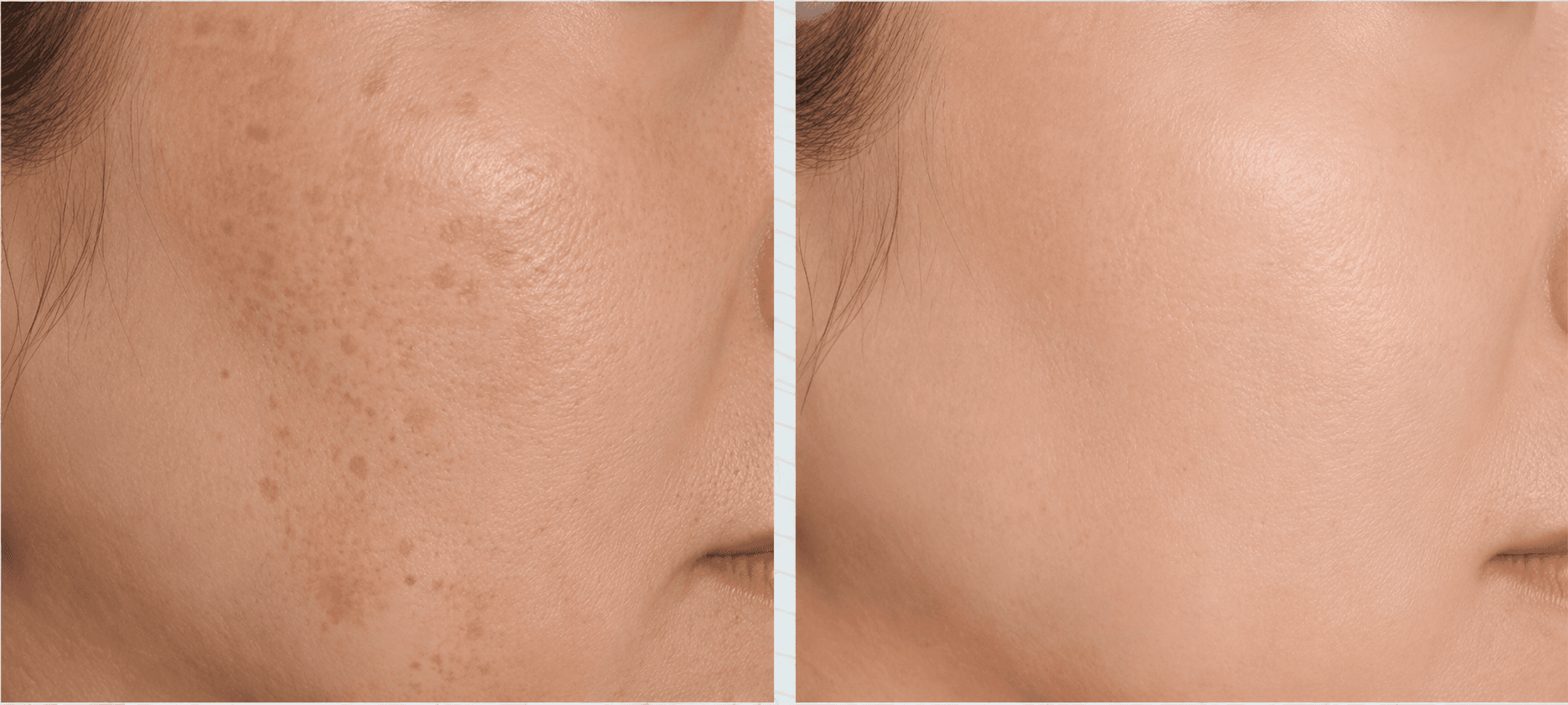 PICO LASER PIGMENTATION RESULTS — Before photo (result 1 of 4)
