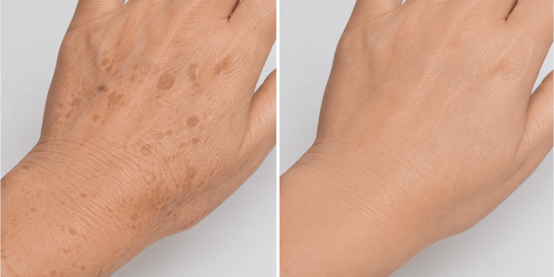 PICO LASER PIGMENTATION RESULTS — Before photo (result 2 of 4)