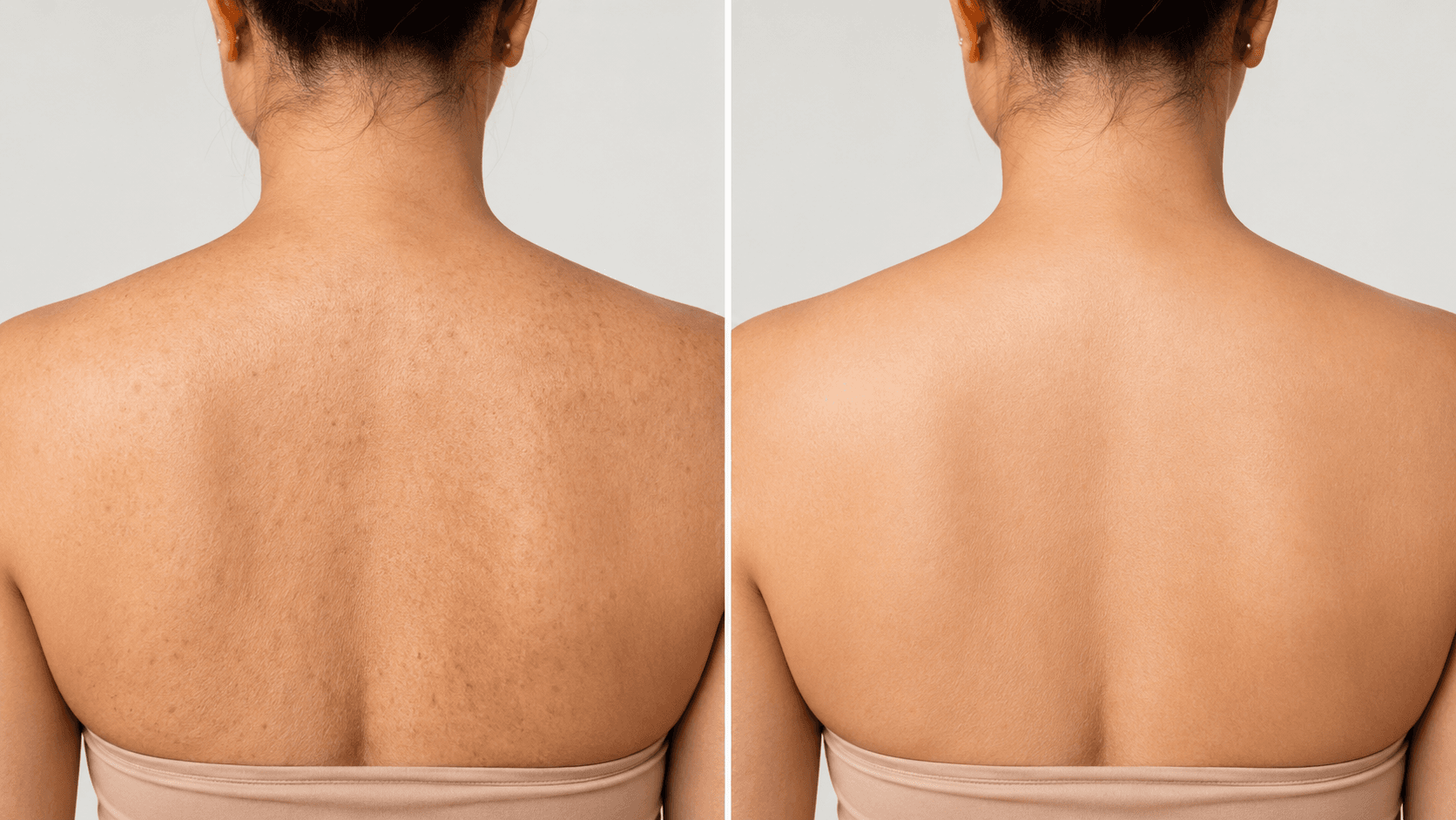 PICO LASER PIGMENTATION RESULTS — Before photo (result 3 of 4)