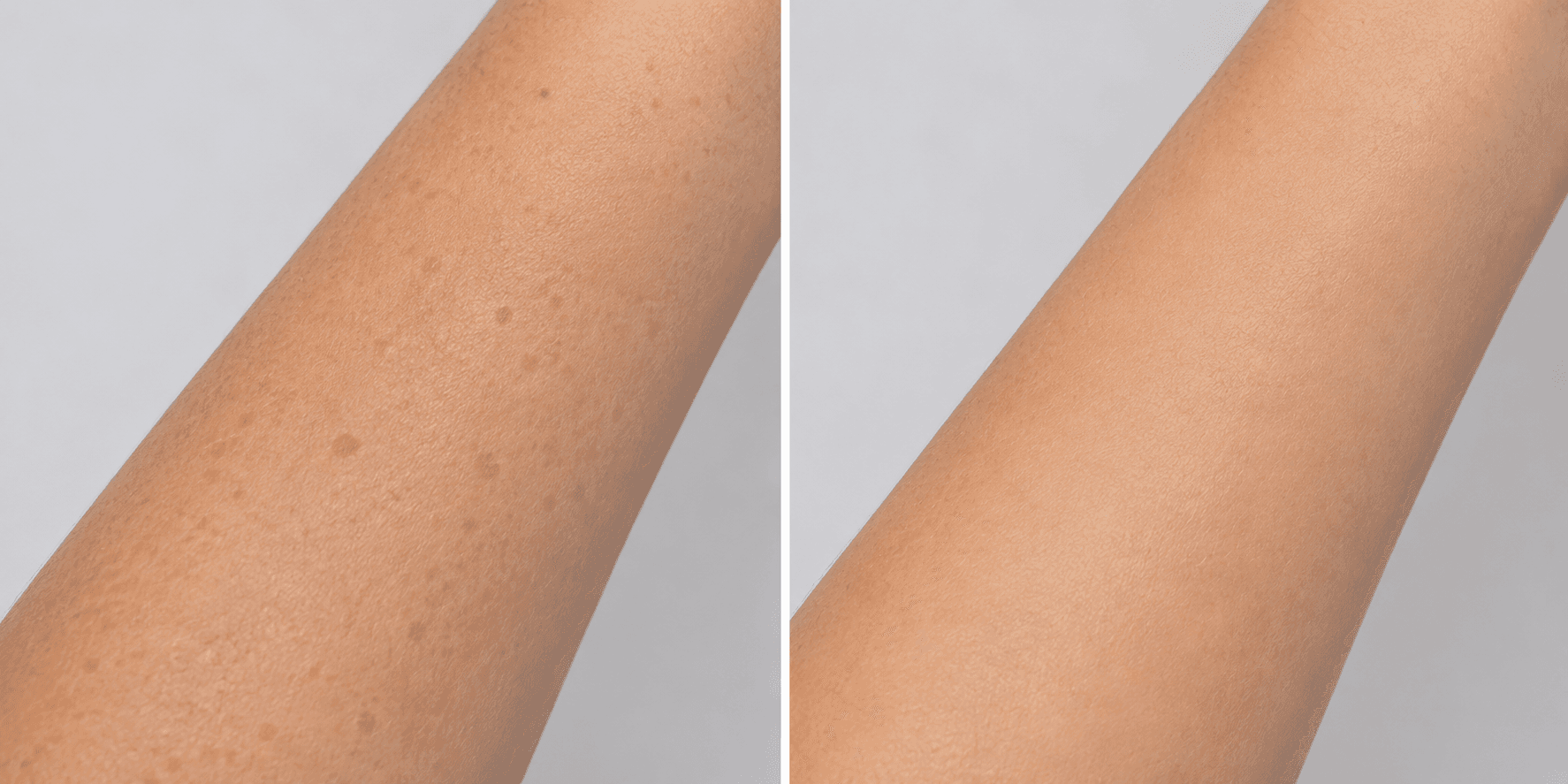 PICO LASER PIGMENTATION RESULTS — Before photo (result 4 of 4)