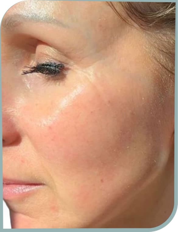 Crepey eye area skin, After photo (result 1 of 10)