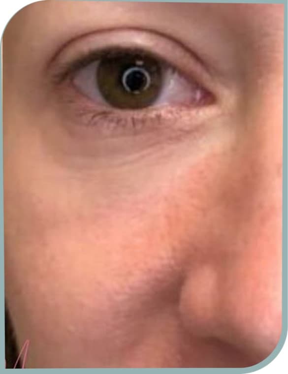 Under eye lines, After photo (result 9 of 10)