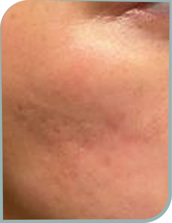 Uneven cheek texture, After photo (result 10 of 10)