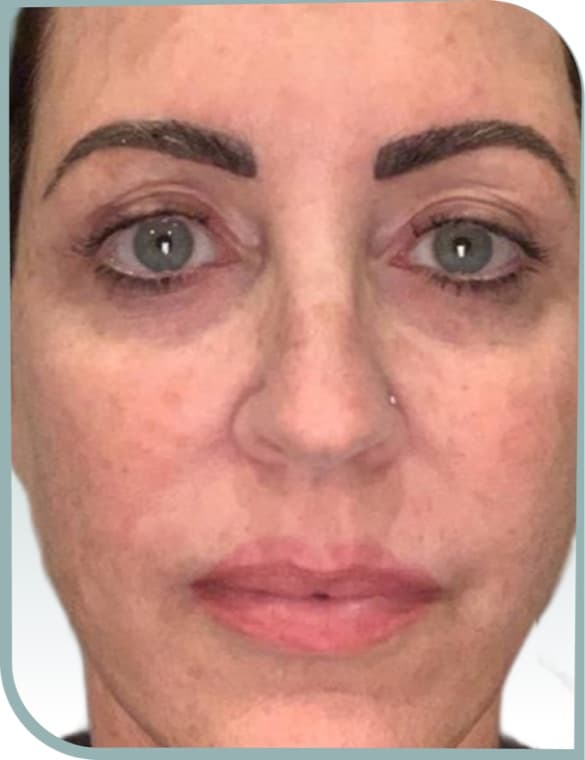 Dark under eye circles, Before photo (result 2 of 10)
