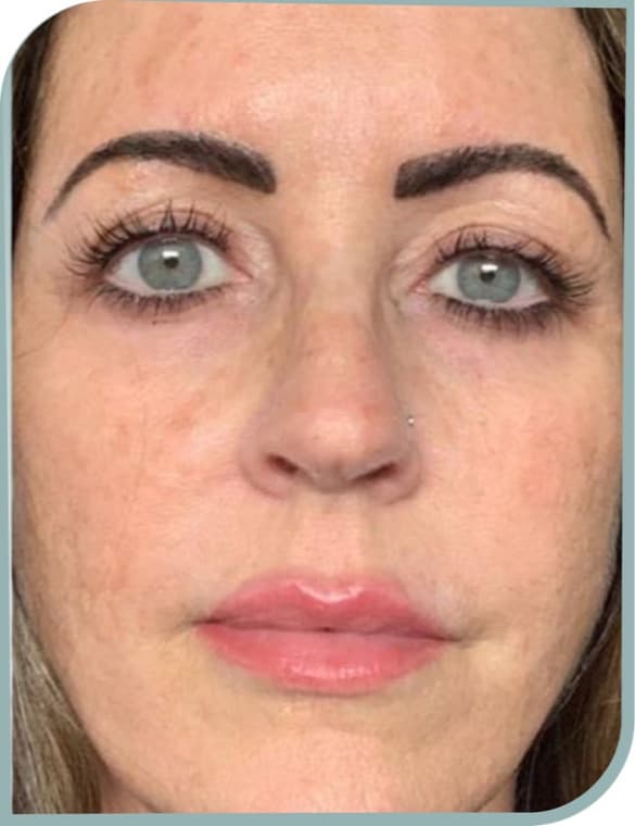 Dark under eye circles, After photo (result 2 of 10)