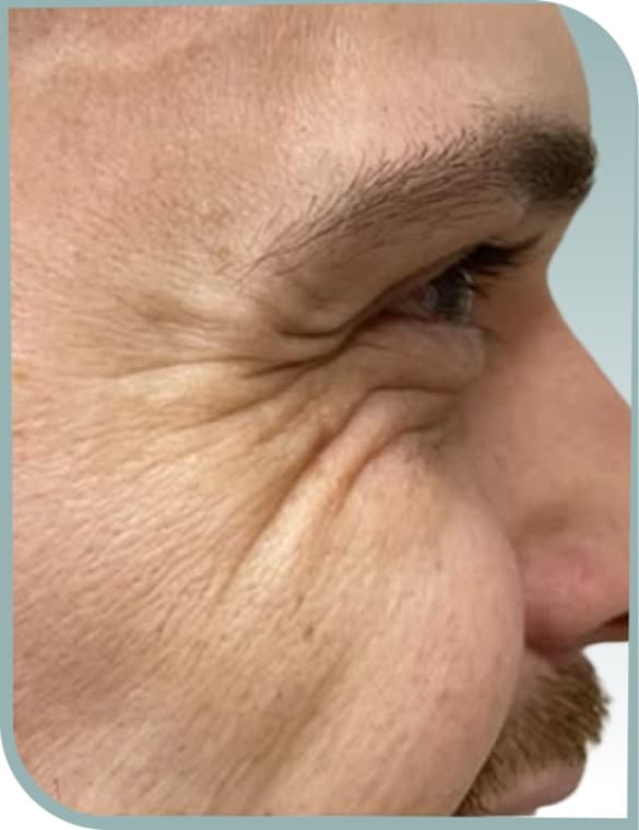 Deep crow's feet, Before photo (result 3 of 10)