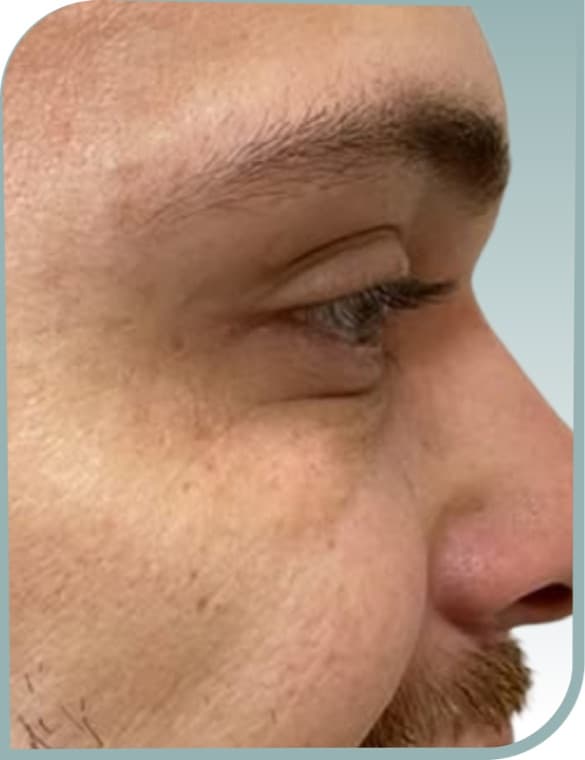 Deep crow's feet, After photo (result 3 of 10)