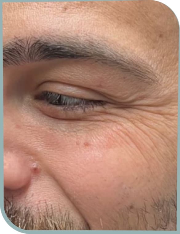 Crepey under eye texture, Before photo (result 4 of 10)