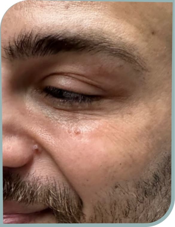 Crepey under eye texture, After photo (result 4 of 10)
