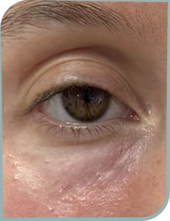 Under eye fine lines, After photo (result 5 of 10)