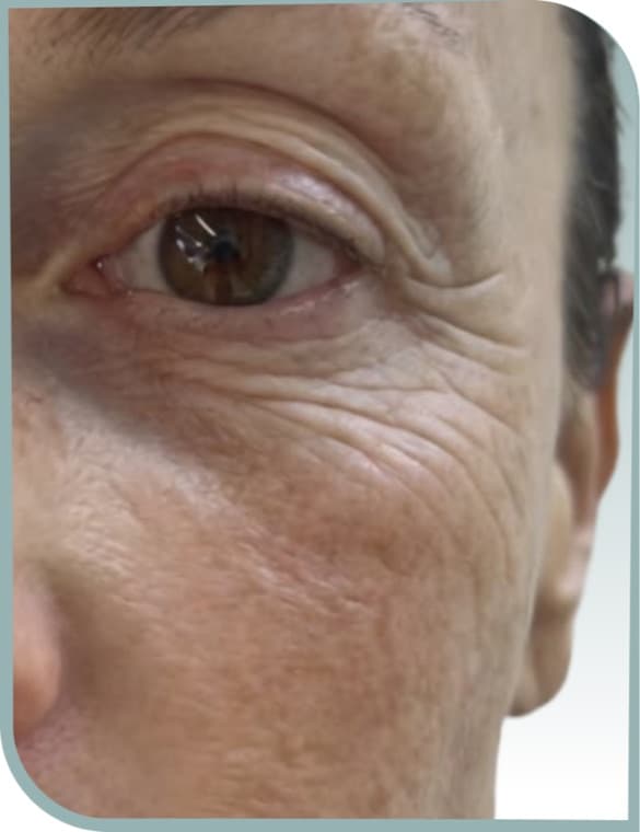 Deep crepey eye lines, Before photo (result 6 of 10)