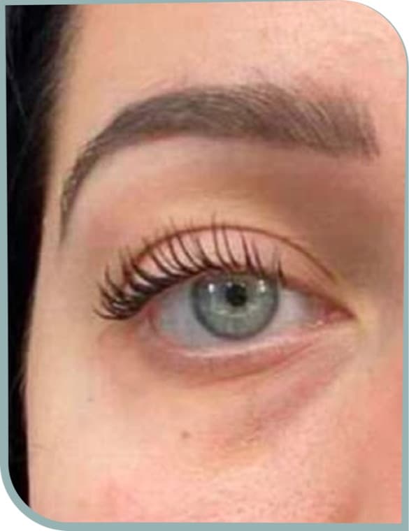 Under eye puffiness, Before photo (result 7 of 10)