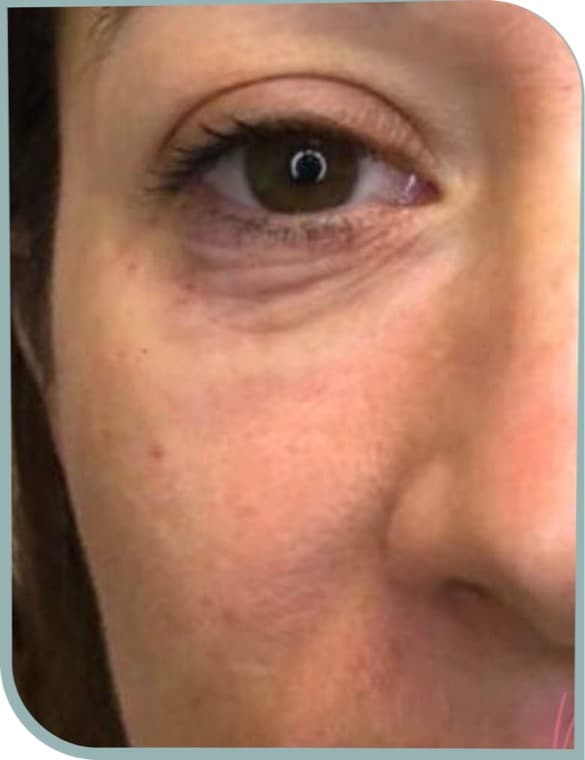 Under eye lines, Before photo (result 9 of 10)
