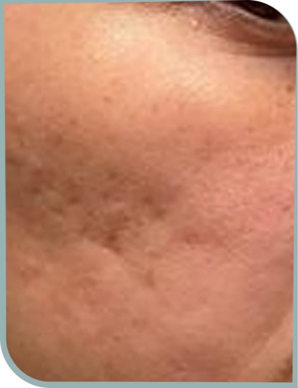 Uneven cheek texture, Before photo (result 10 of 10)