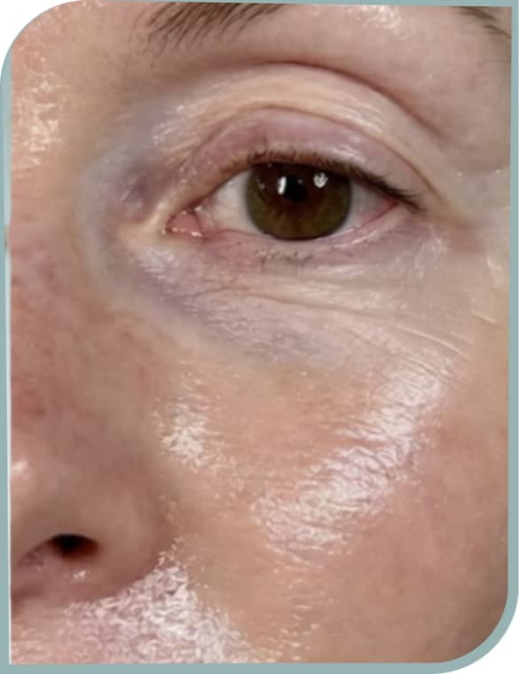 Deep crepey eye lines, After photo (result 6 of 10)