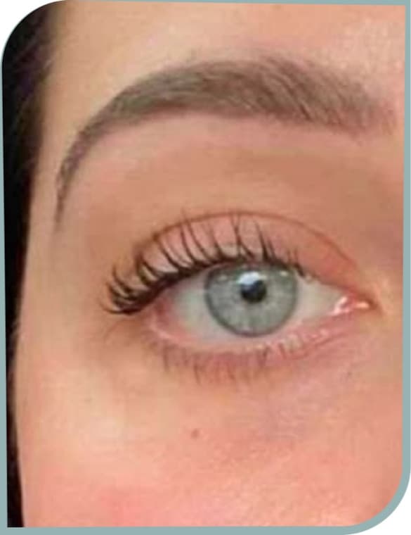 Under eye puffiness, After photo (result 7 of 10)