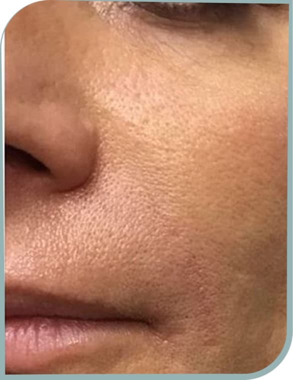 Enlarged cheek pores, After photo (result 8 of 10)