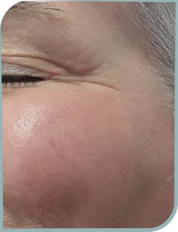 Crow's feet, After photo (result 1 of 10)