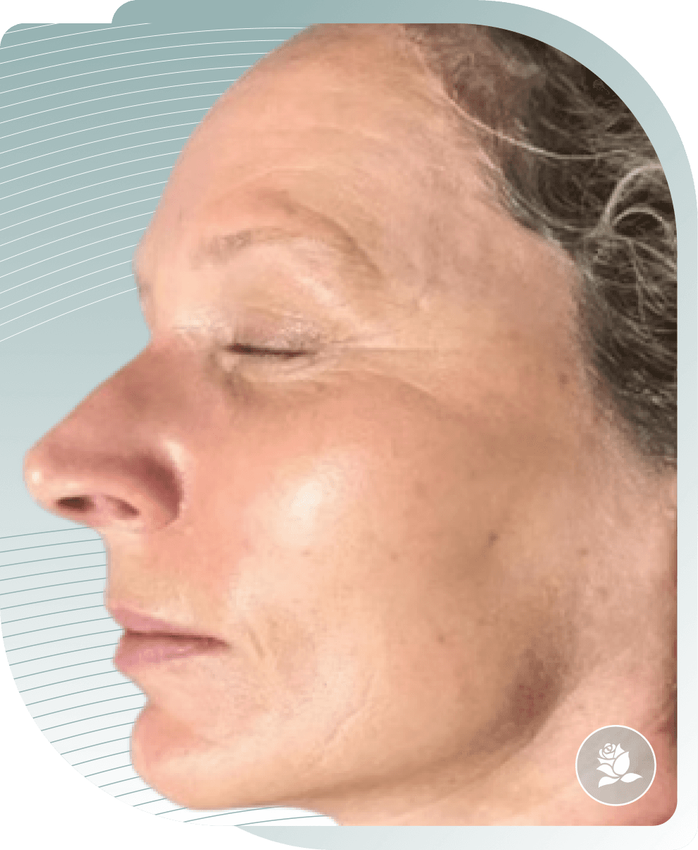 Face Rejuvenation — After photo (result 1 of 5)
