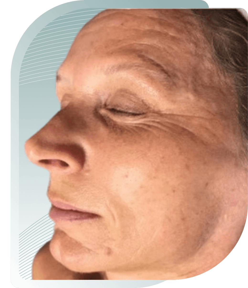 Face Rejuvenation — Before photo (result 1 of 5)