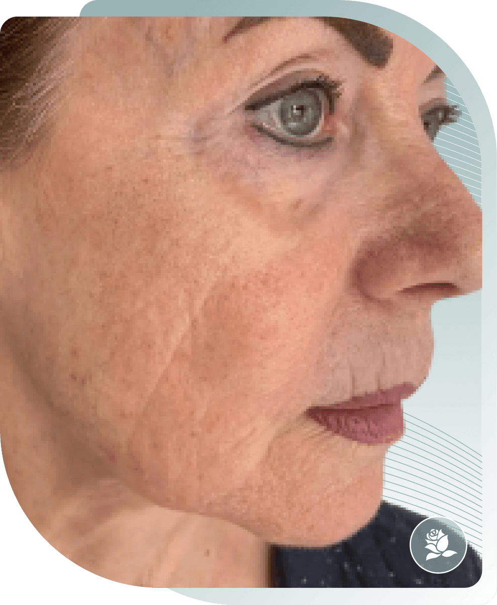 Skin Quality — After photo (result 2 of 5)