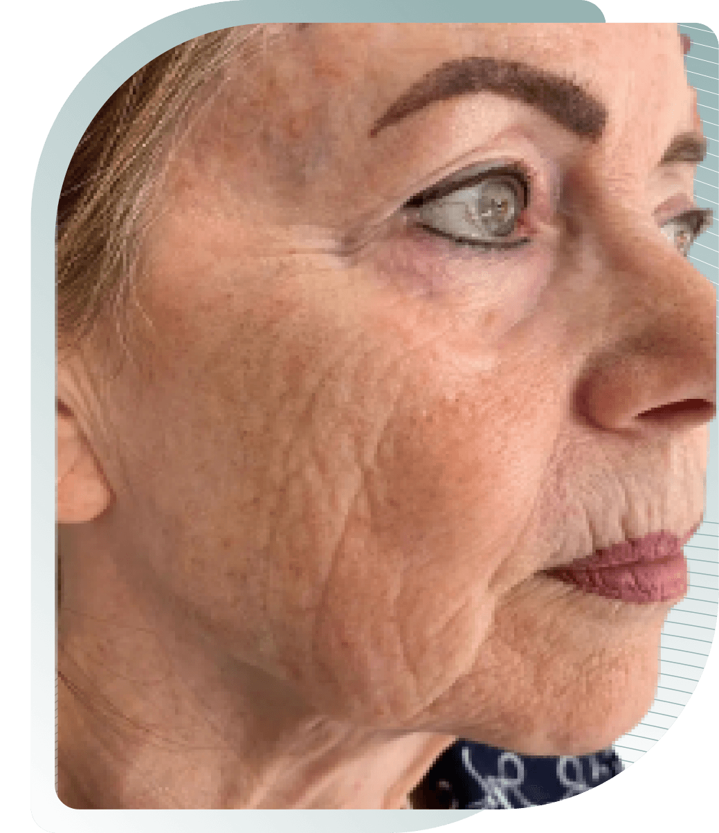 Skin Quality — Before photo (result 2 of 5)