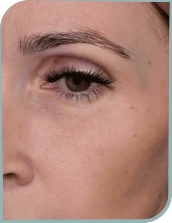 Under eye texture, After photo (result 3 of 10)