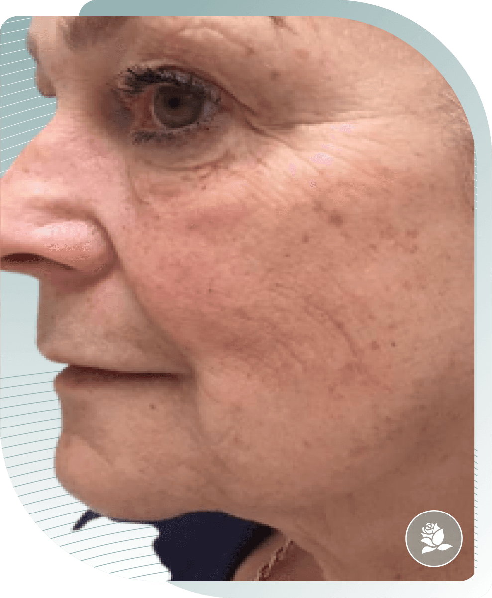 Skin Texture — After photo (result 3 of 5)