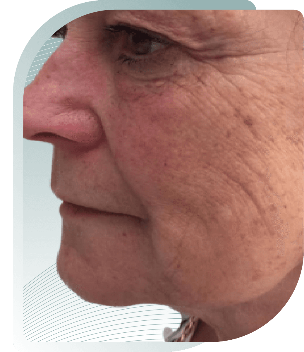 Skin Texture — Before photo (result 3 of 5)