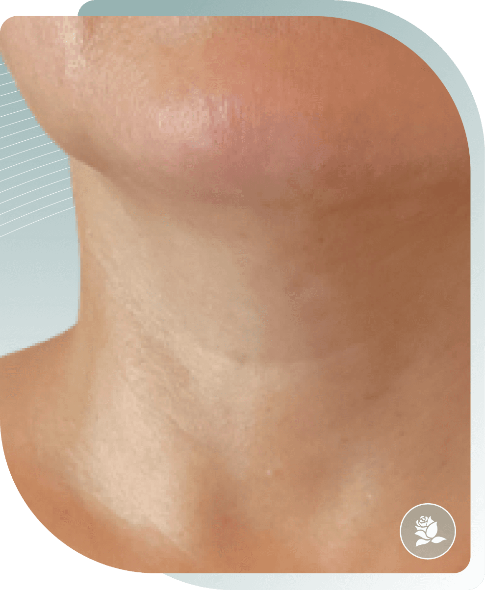 Neck Treatment — After photo (result 4 of 5)